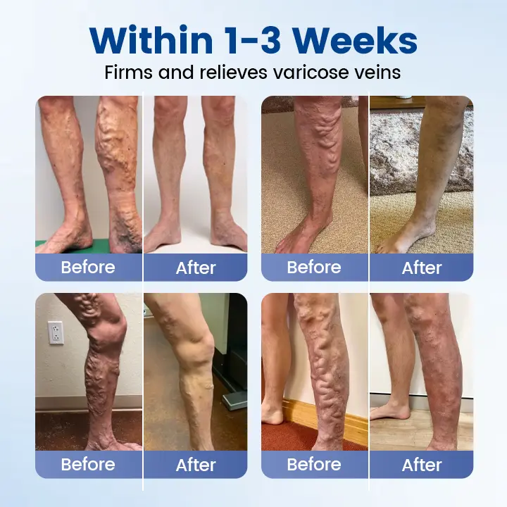 Vein Ease Microneedle Therapy Patch - Fast ⚡Effective 💪 and Non-Invasive 🚫 Treatment for Varicose Veins & Leg Swelling 👣 - Image 10