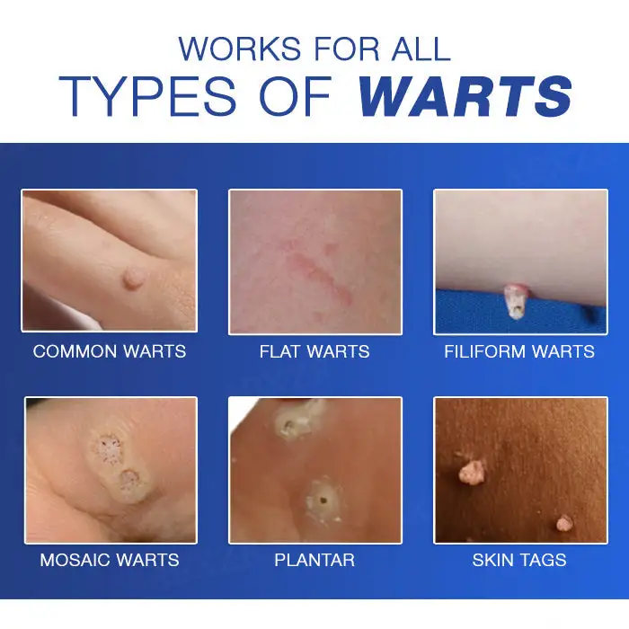 🔥Warts No More - 50% OFF | Wart Eraser Pro - Image 6