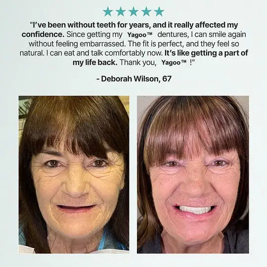Custom Custom-Fit Full Functional DenturesMake you more confident - Image 3