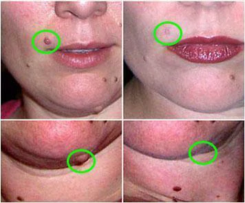 Mole & Skin Tag Removal Solution - Image 2