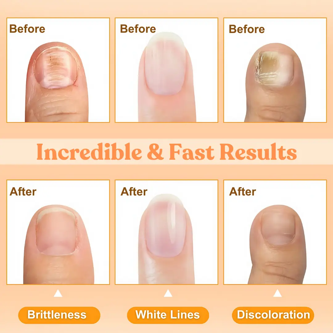 Bee Venom Nail Repair Treatment Spray - Image 4