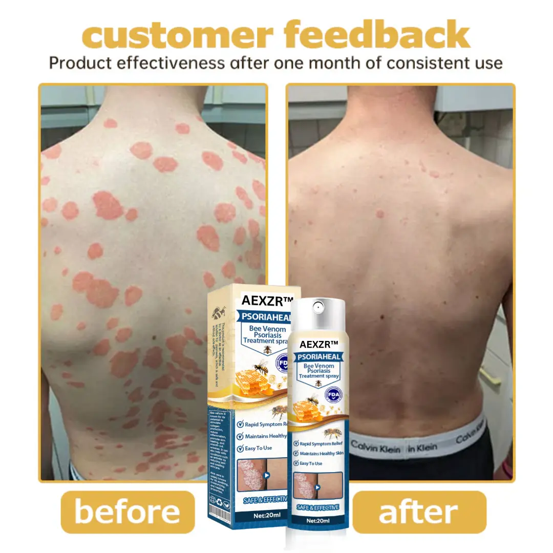 PsoriaHeal Bee Venom Psoriasis Treatment Spray - Image 7
