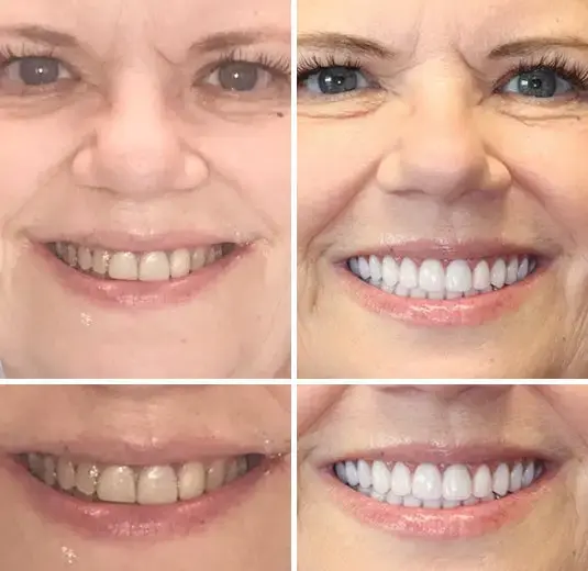 Advanced Customized Full Denture Set - Image 7