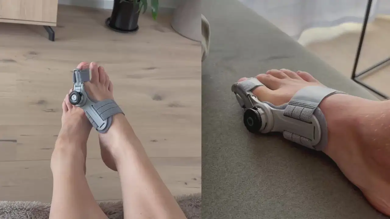 Non-Surgical Relief for Bunion Pain - Image 3