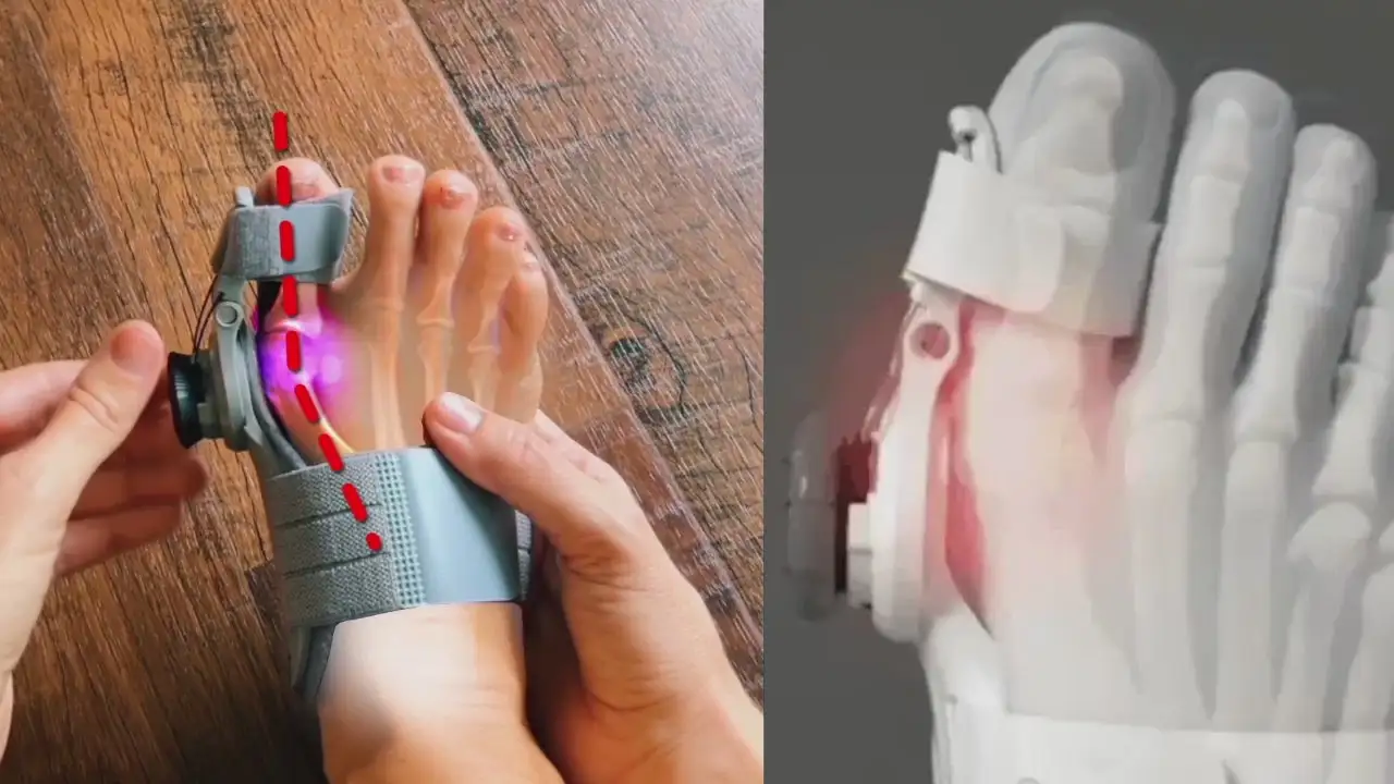 Non-Surgical Relief for Bunion Pain - Image 4