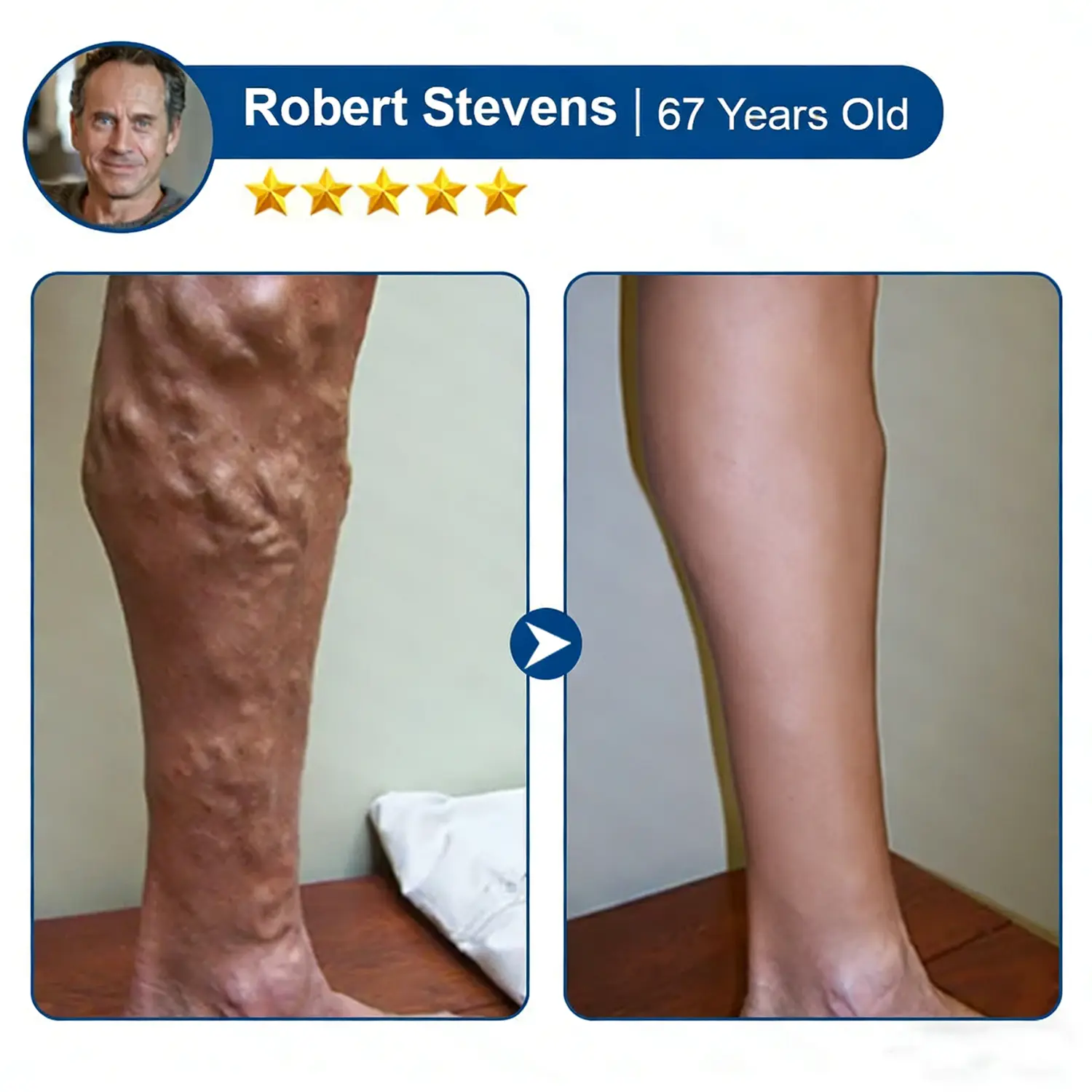 Vein Contour Micro-Patches: The 7-Day Transformation for Varicose Veins - Image 12
