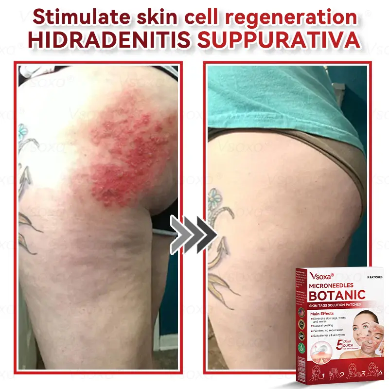 Microneedles Botanical Skin Tags Solution Patches - Image 8