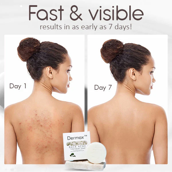 Back Acne Treatment Soap - Image 5