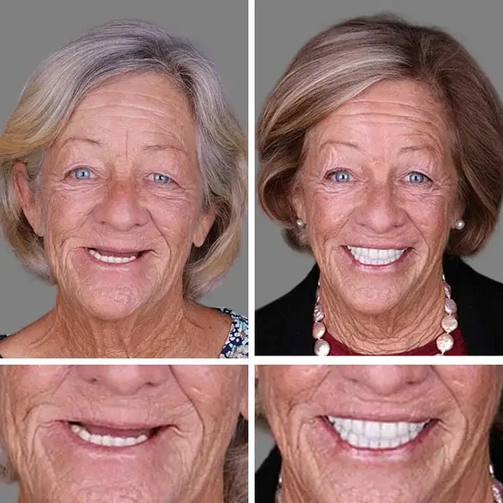 🌎Ends Today: 70% OFF! Medical Full Denture with Strong Suctiond - Image 10