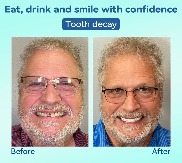 Premium Denture AdaptableFit Functional Dentures - Image 10