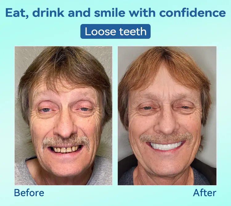 Premium Denture AdaptableFit Functional Dentures - Image 11