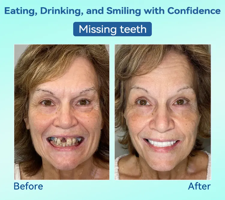 Premium Denture AdaptableFit Functional Dentures - Image 12
