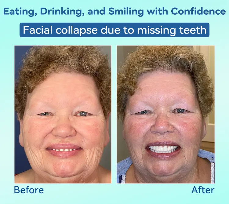 Premium Denture AdaptableFit Functional Dentures - Image 13