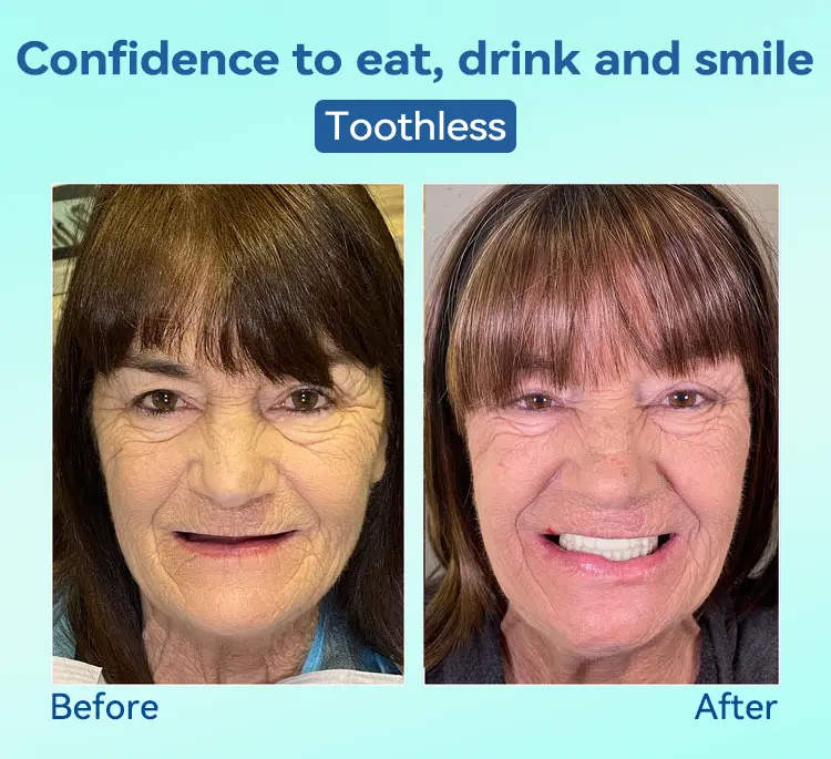 Premium Denture AdaptableFit Functional Dentures - Image 7