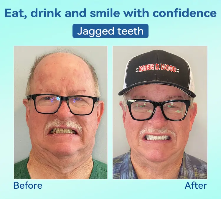 Premium Denture AdaptableFit Functional Dentures - Image 9