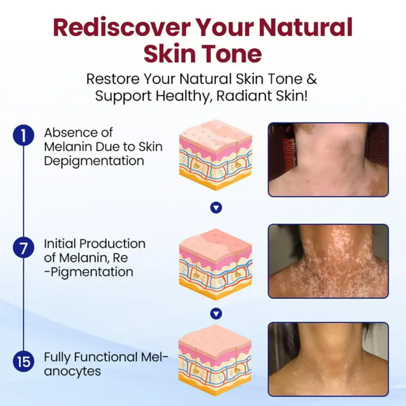 Rapid Repair Vitiligo Essence - Image 2