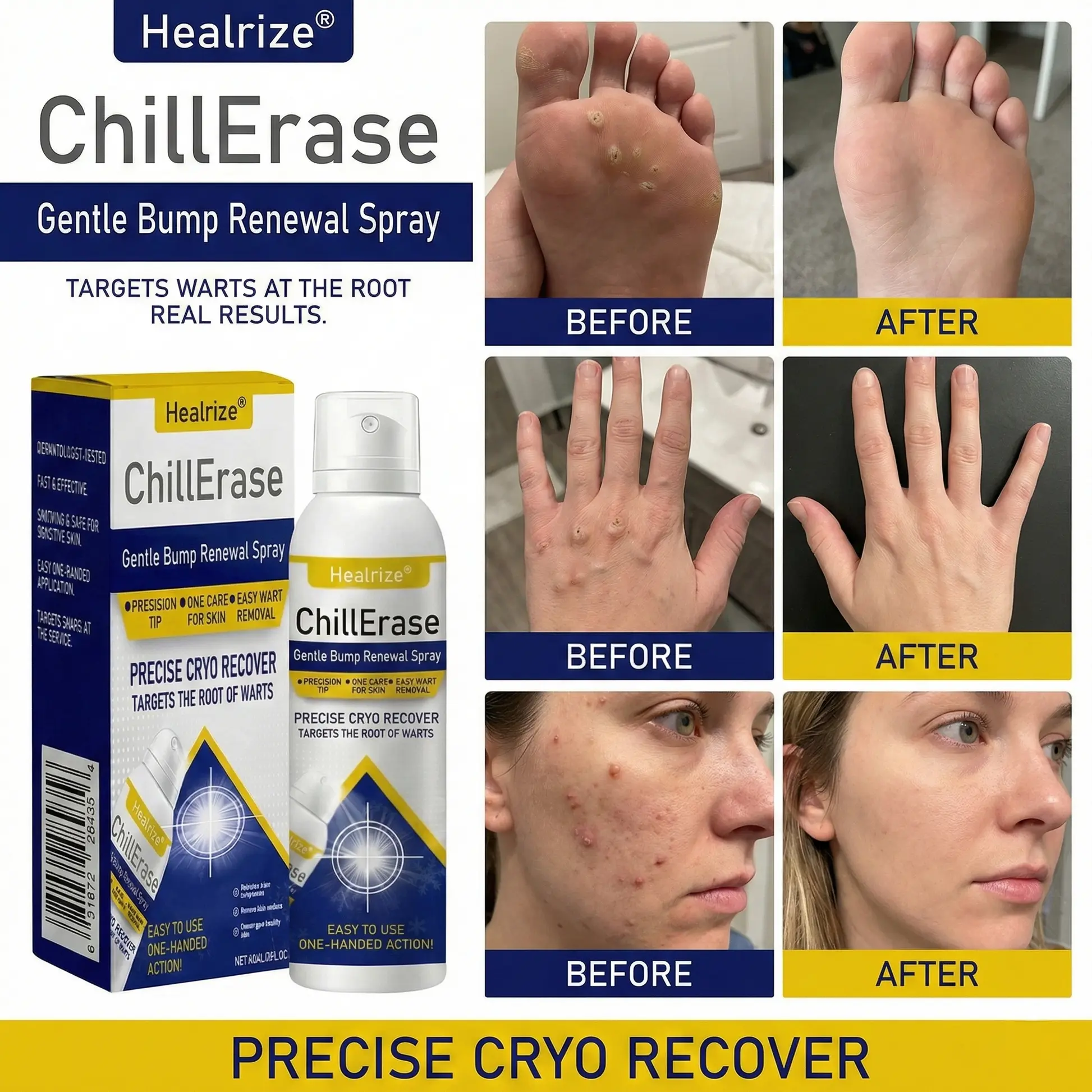 ChillErase Gentle Bump Renewal Spray—Stubborn Skin Bumps & Rough Spots - Image 3