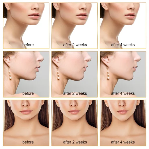 Intelligent EMS V Face Massager - Image 7