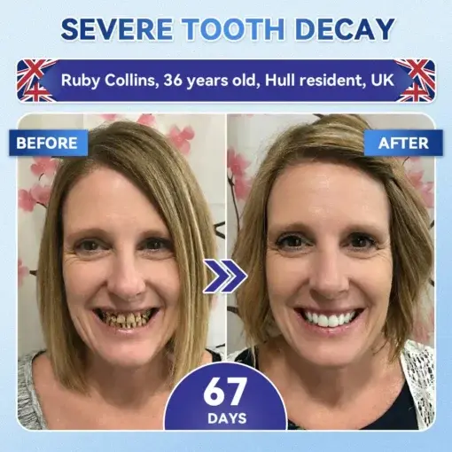 Tideglusib Fast‑Dissolving Tooth & Gum Repair Oral Strips - Image 4