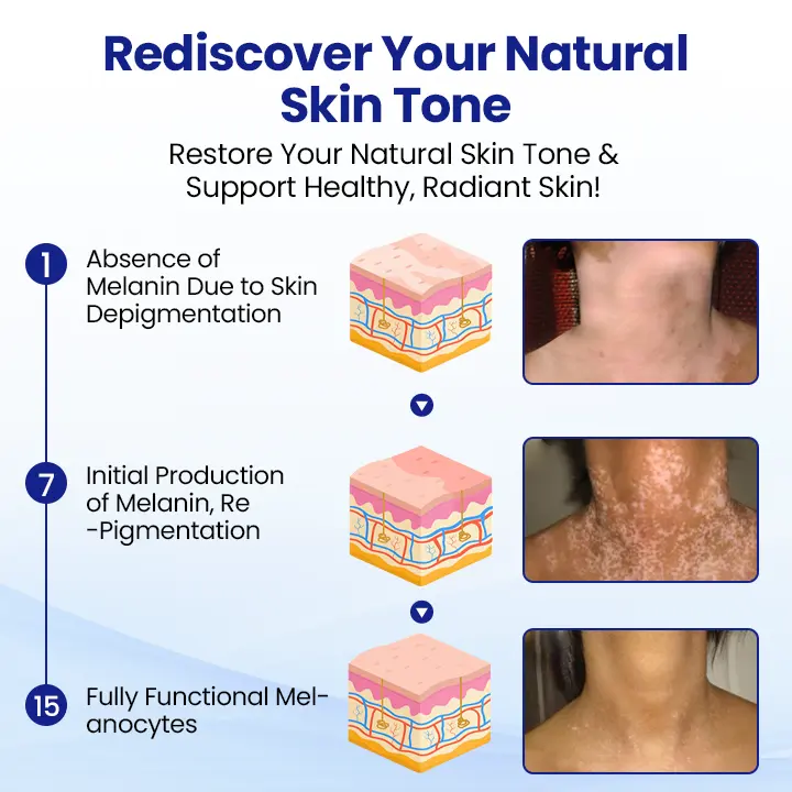 Vitiligo Repigmentation Spray - Image 5