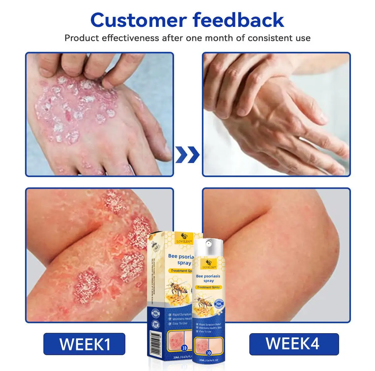 PsoriaHeal Bee Psoriasis Treatment Spray pro - Image 2