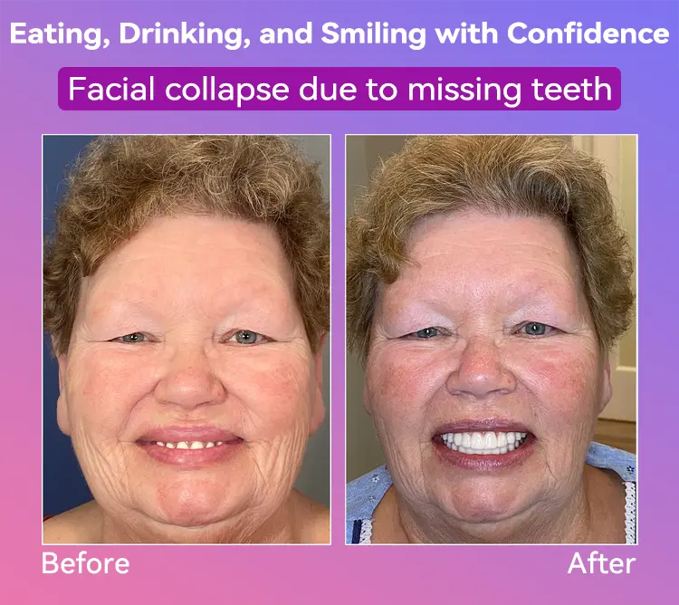 Latest Premium Comfort Dentures - Image 11