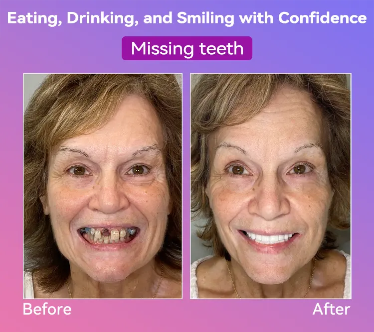 Latest Premium Comfort Dentures - Image 13