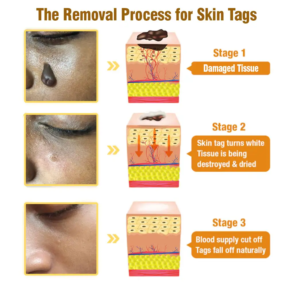 Australian Bee Venom Tags Removal Cream - Image 6