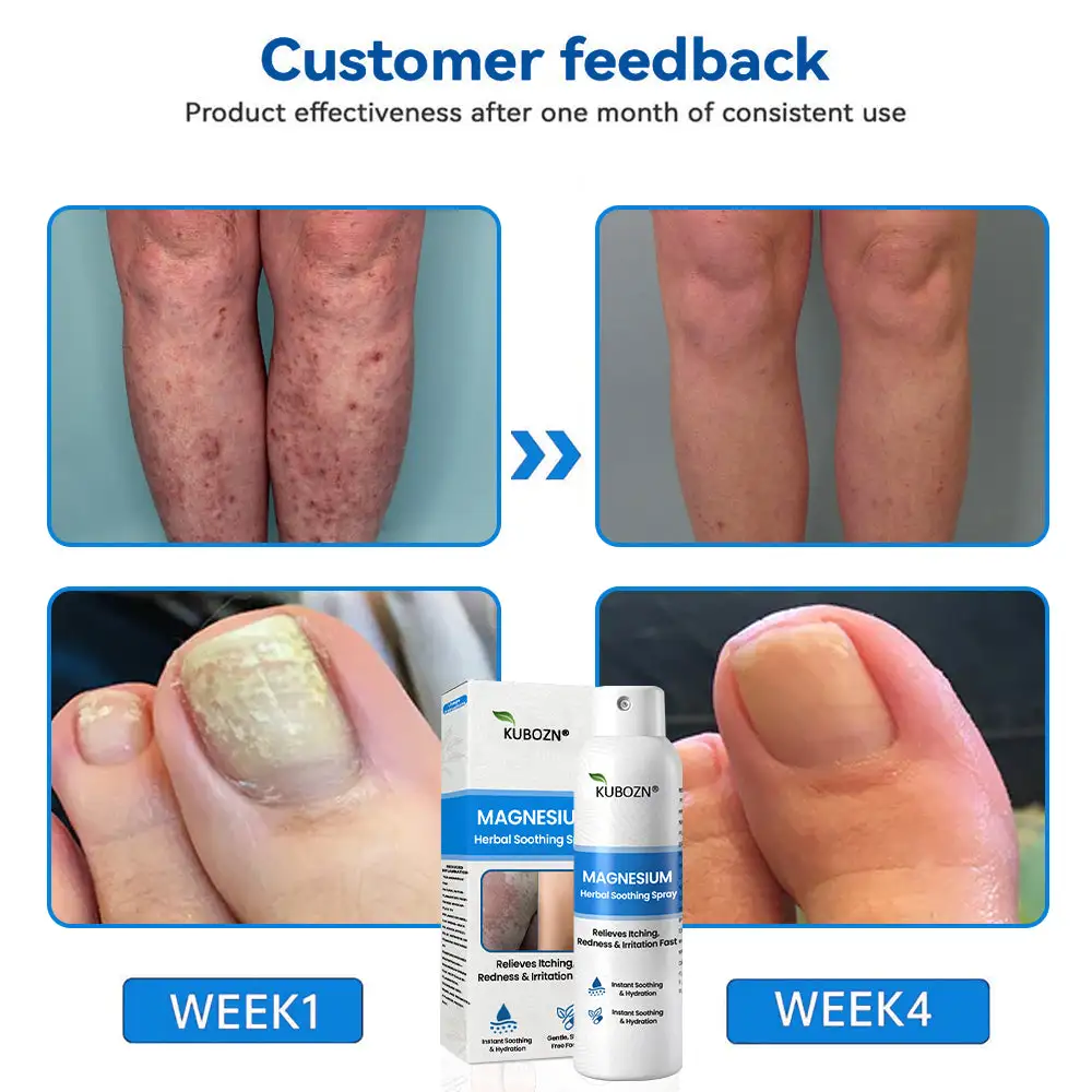 Magnesium Herbal Psoriasis Spray - Image 10