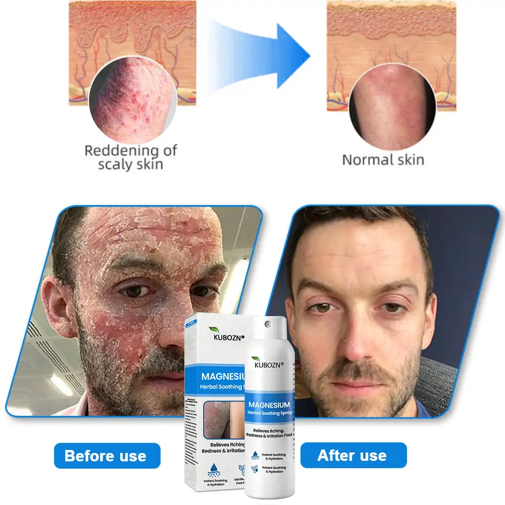 Magnesium Herbal Psoriasis Spray - Image 11