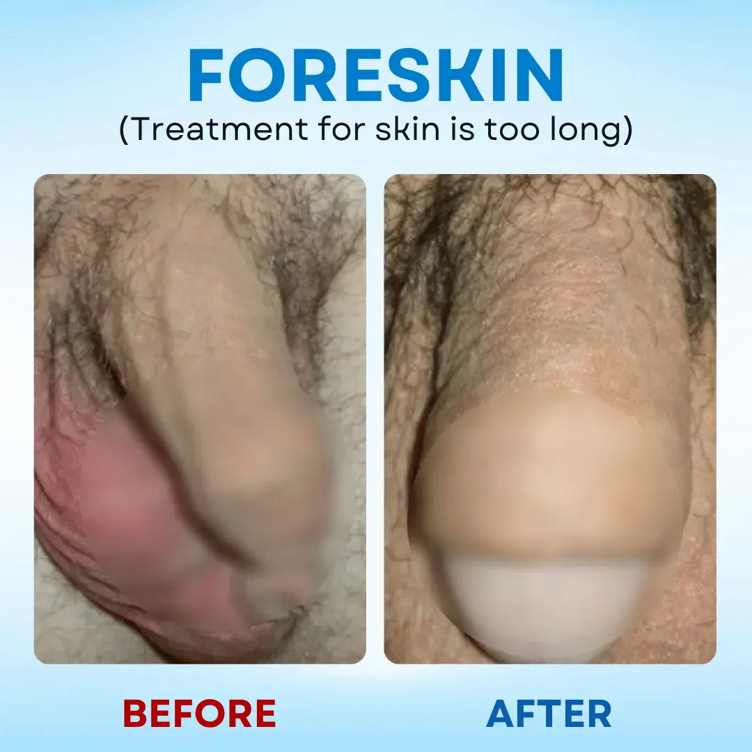 7-Day Redundant Prepuce Corrective Gel - Image 5