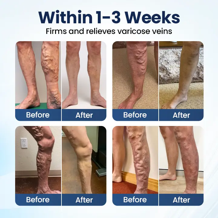 Deep Vein Repair Microneedle Patch - Image 3