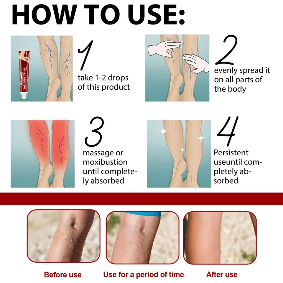 Varicose Veins Relief Cream - Image 5