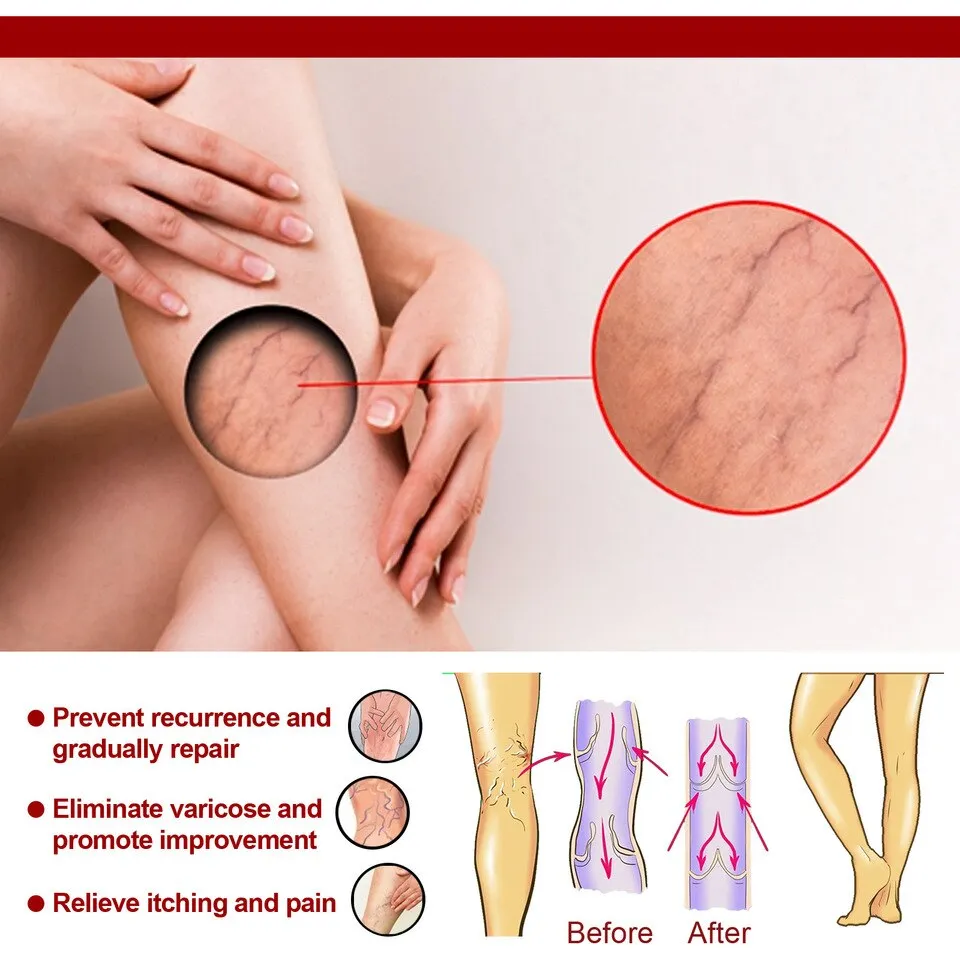 Varicose Veins Relief Cream - Image 4