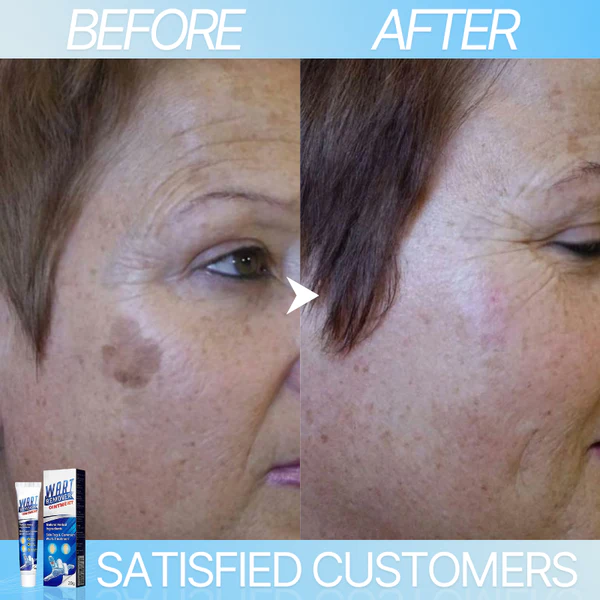 WART-LESS Immediate Blemish Removal Cream - Image 6