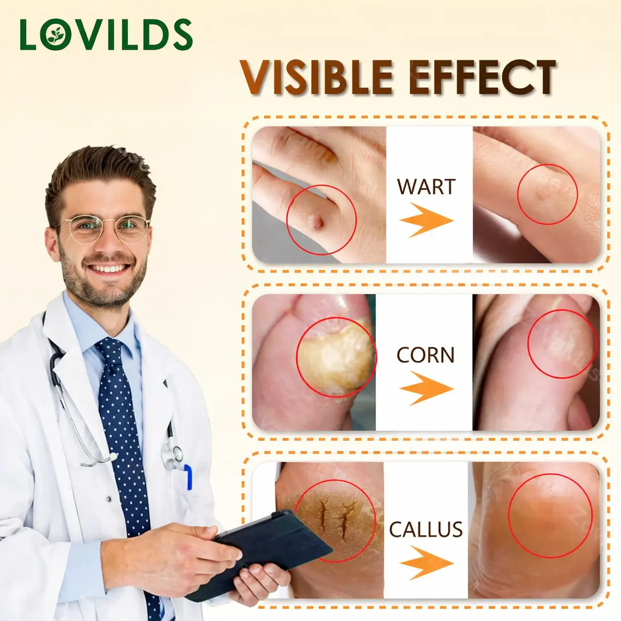 BEE POISON Corn & Callus Remover Cream - LOVILDS - Image 2