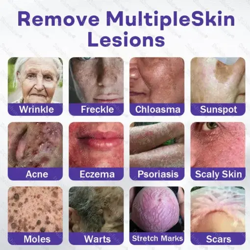 Wart and mole removal microneedle patch - Image 2