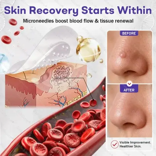 Wart and mole removal microneedle patch - Image 4