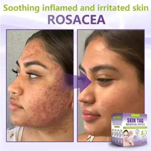 Soluble Microneedle Botanical Skin Tag Removal Patch - Image 11