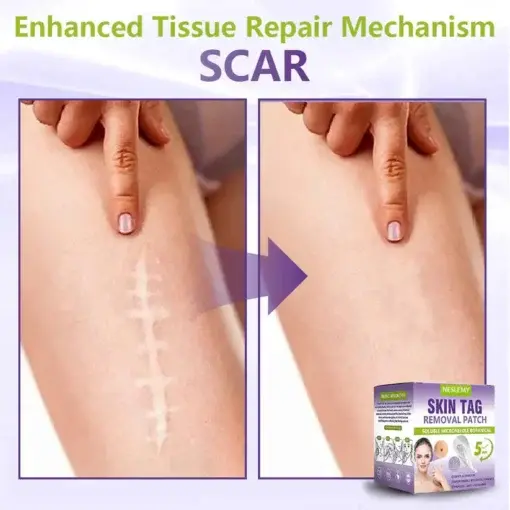 Soluble Microneedle Botanical Skin Tag Removal Patch - Image 13
