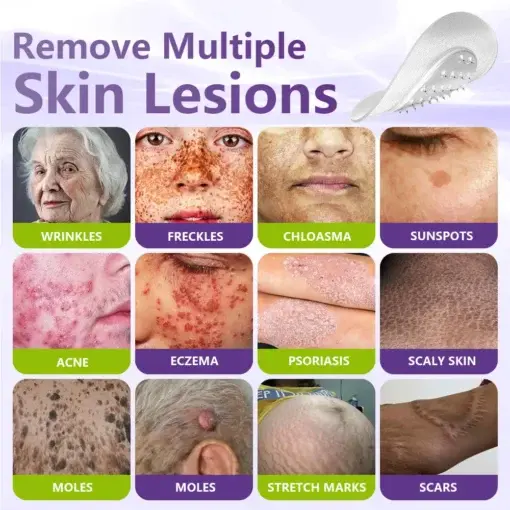 Soluble Microneedle Botanical Skin Tag Removal Patch - Image 3