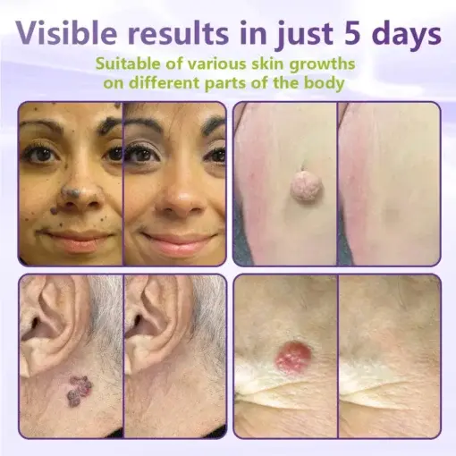 Soluble Microneedle Botanical Skin Tag Removal Patch - Image 4