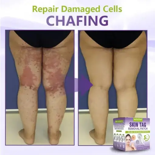 Soluble Microneedle Botanical Skin Tag Removal Patch - Image 7