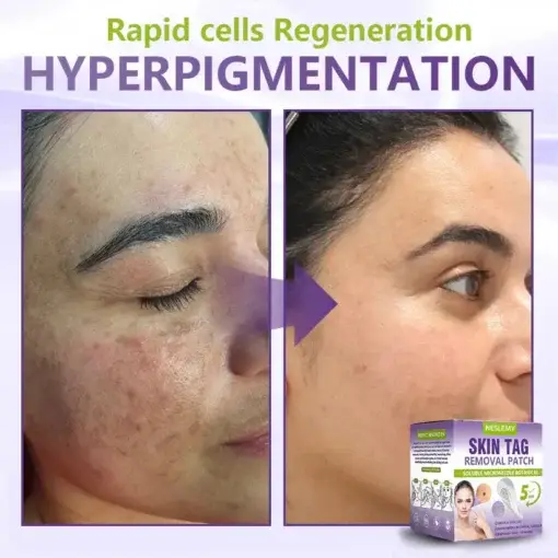 Soluble Microneedle Botanical Skin Tag Removal Patch - Image 8