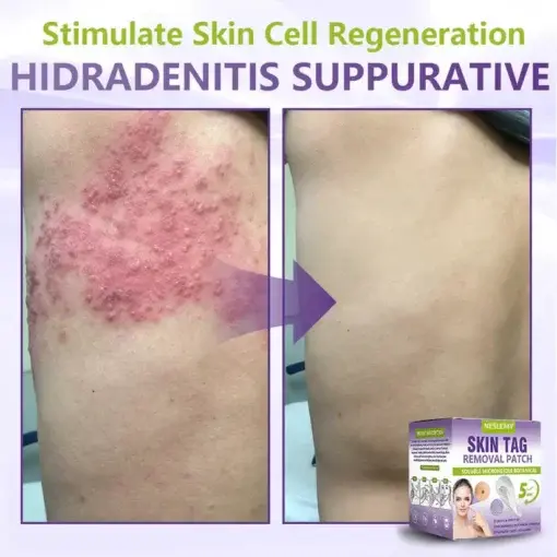 Soluble Microneedle Botanical Skin Tag Removal Patch - Image 9