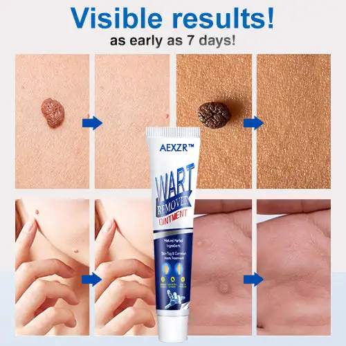 Wart Removal Ointment - Image 5