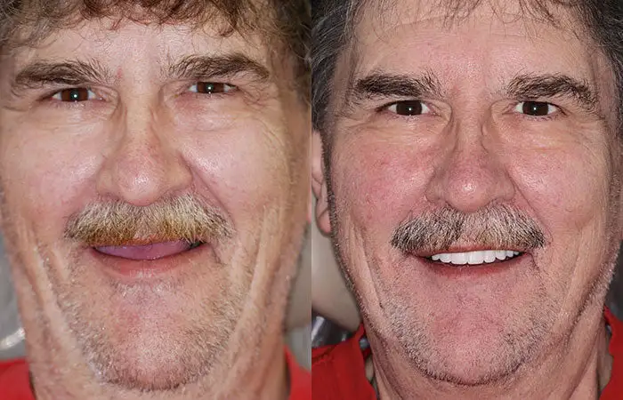Advanced Customized Full Denture Set - Image 10
