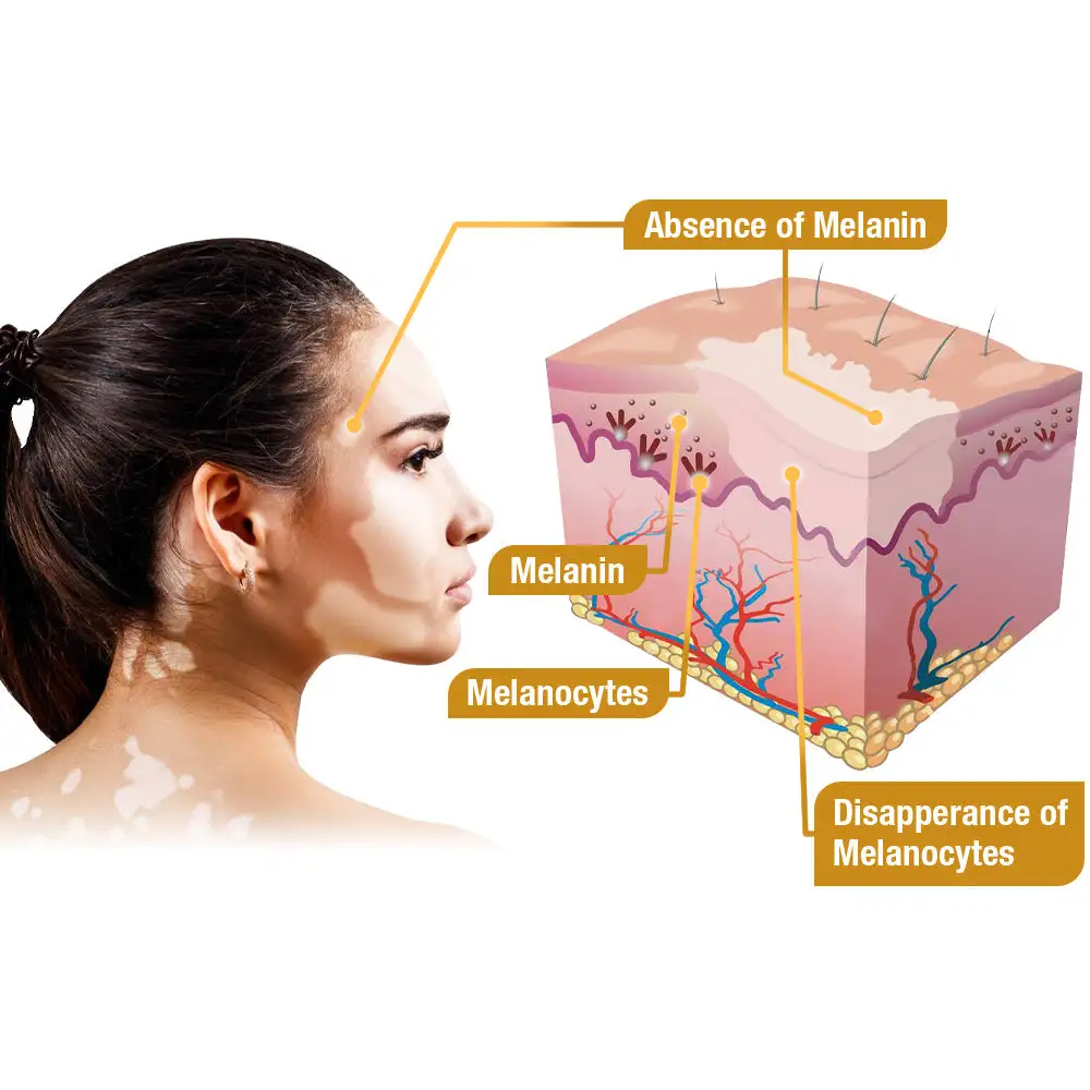 VitiGO Bee Venom Treatment Cream - Image 9