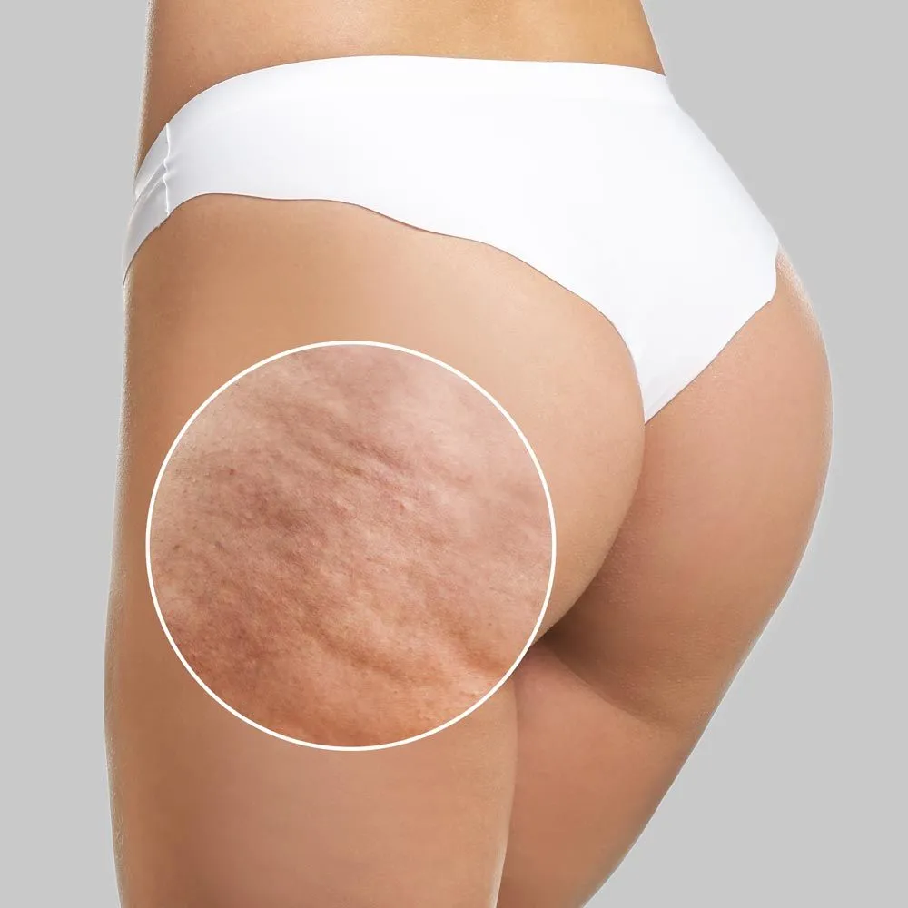 Slimoly Anti Cellulite Massage Oil - Skin Tightening Moisturizing - Image 8