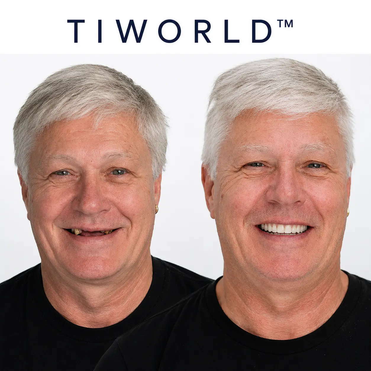 Custom-Fit Dentures - Image 14